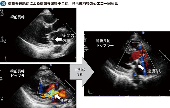 僧帽弁逸脱症 – 日本医事新報社