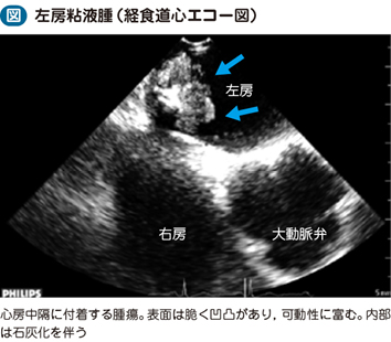 原発性心臓腫瘍（良性） – 日本医事新報社