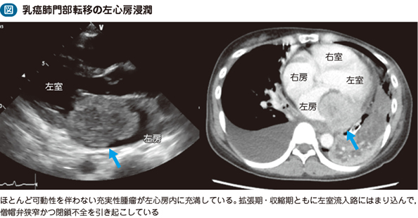 転移性心臓腫瘍 – 日本医事新報社