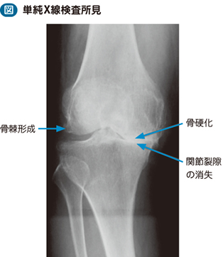 変形性膝関節症 – 日本医事新報社