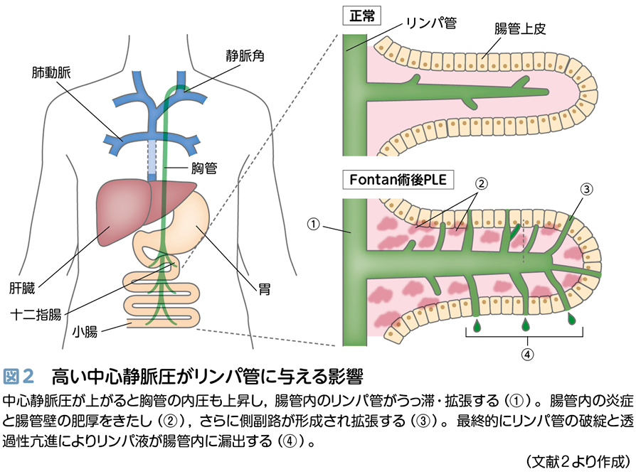 中学2年生女性の入院拒否 ～Fontan術後遠隔期の問題点～【小児循環器