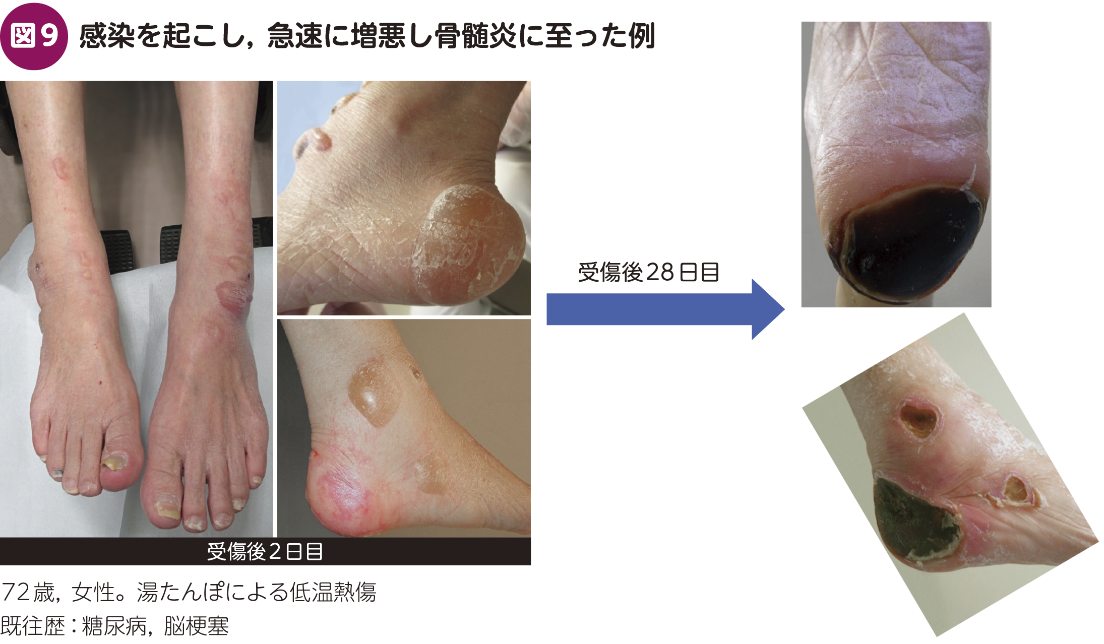 FOCUS：内科で見逃さない！ 糖尿病足病変〈かかりつけ医が気づくべき