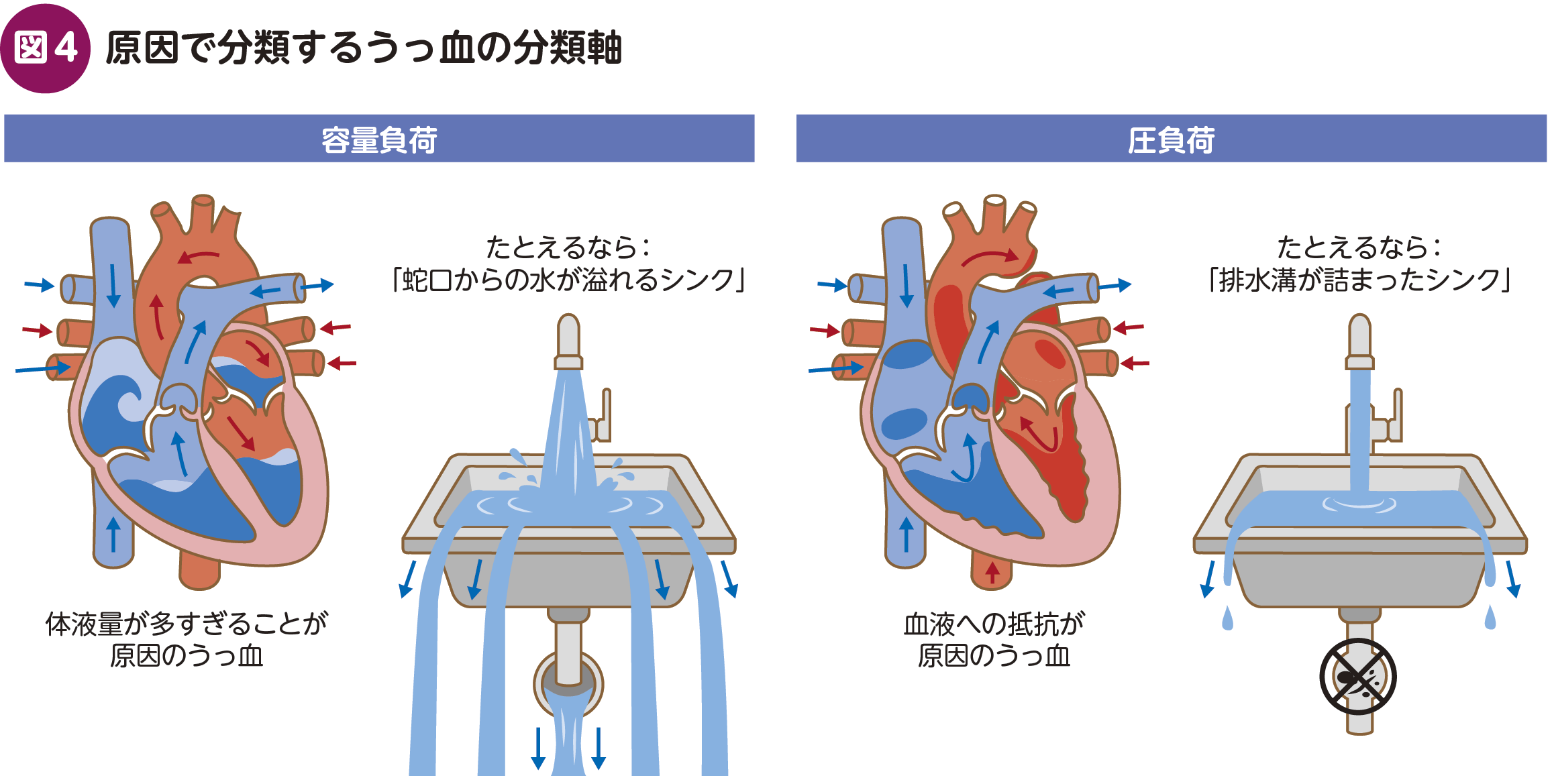 もう1つは体液量が主な原因か,抵抗が主な原因かという視点,つまり容量負荷か圧負荷かという軸だ( 図 4