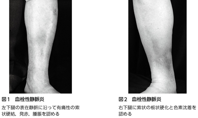 血栓性静脈炎の病理