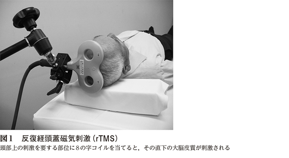 2）精神疾患・てんかんに対する 脳刺激療法 ［特集：脳刺激療法で治療