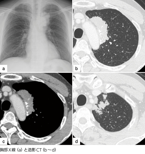 喫煙者の胸部X線・CTでの腫瘤影……炎症性肉芽腫？肺結核？［画像診断