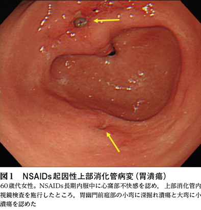 1）NSAIDsによる消化管傷害［特集：薬剤性消化管傷害の現状と対応