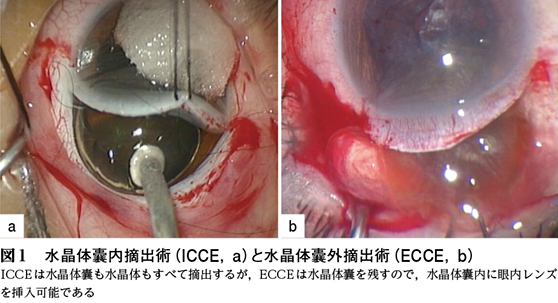 小切開創白内障手術 41zt9XqCoaL.jpg