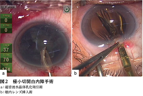 小切開創白内障手術 41zt9XqCoaL.jpg