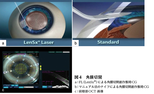 話題1】フェムトセカンドレーザー白内障手術［特集：今、話題に
