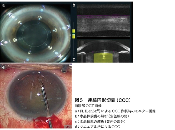 話題1】フェムトセカンドレーザー白内障手術［特集：今、話題になって