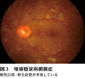 話題5】糖尿病網膜症における抗VEGF薬の役割［特集：今、話題になって