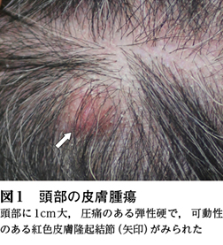 1）Ⅰ 内臓悪性腫瘍の皮膚病変─1 皮膚転移群，がん皮膚転移［特集