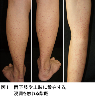 12）Ⅳ 消化器病の皮膚病変─1 IgA血管炎［特集：皮膚病変でみる内科