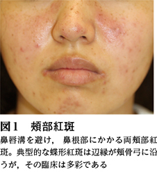 15）Ⅵ 膠原病の皮膚病変（皮膚筋炎以外）─全身性エリテマトーデス
