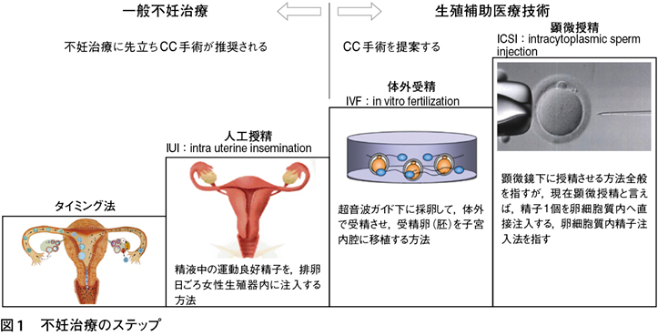 論点】不妊症患者に対するチョコレート囊胞手術治療の優先度