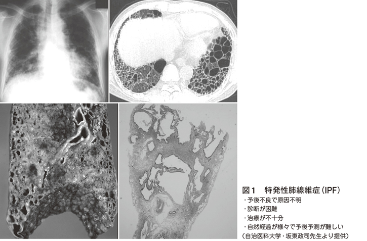 間質性肺炎の臨床　画像　診断　裁断 メジカルビュー社｜臨床画像特集一覧｜臨床画像 2018年2月号