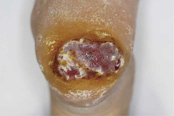 糖尿病性足潰瘍？ それとも…［画像診断道場～実はこうだった（118