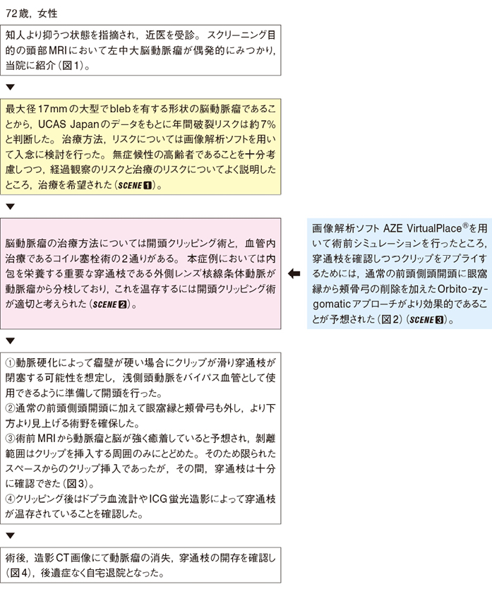 中大脳動脈瘤(MCA Aneurysm)のすべて: シミュレーションで経験する手術・IVR 50本のWEB動画付き (脳神経外科速報EX部位別に学ぶ脳動脈瘤シリーズ) 内頚動脈瘤(ICA Aneurysm)のすべて-遠位部(supraclinoid
