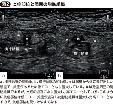 特集 POCUSのはじめ方 クリニックでの腹部診療イノベーション 肝胆膵編