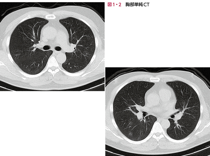 人間ドックの胸部CT異常陰影［画像診断道場～実はこうだった