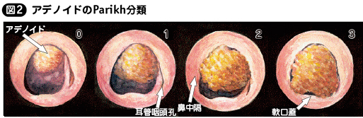 扁桃肥大・アデノイド増殖症［私の治療］ – 日本医事新報社
