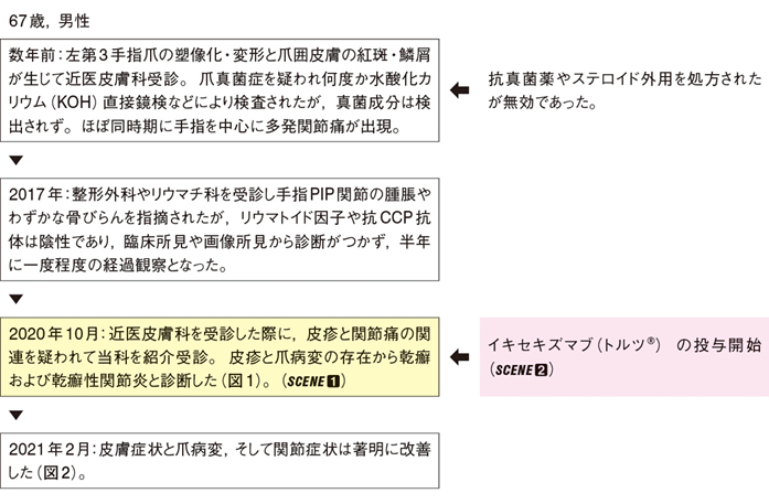 治療的診断のため生物学的製剤を投与した乾癬性関節炎［難渋症例から