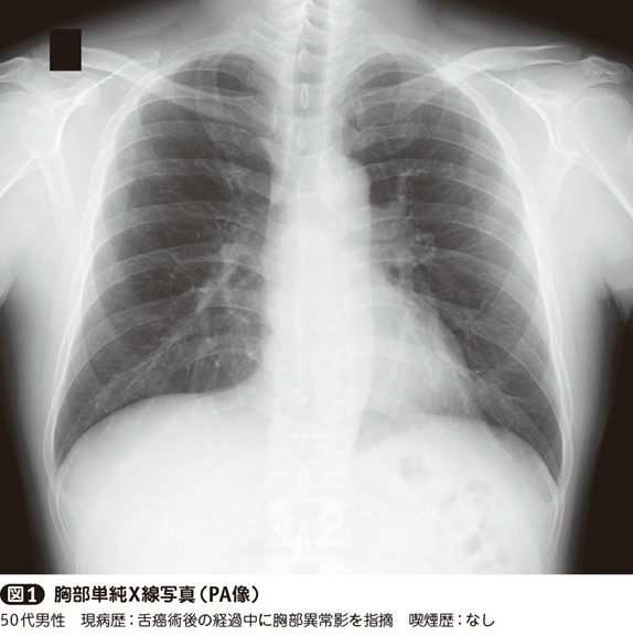 この病変から考えられる疾患は？［胸部画像診断トレーニング（38
