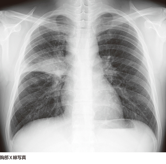 肺炎？それとも……［画像診断道場～実はこうだった（202）］ – 日本医事