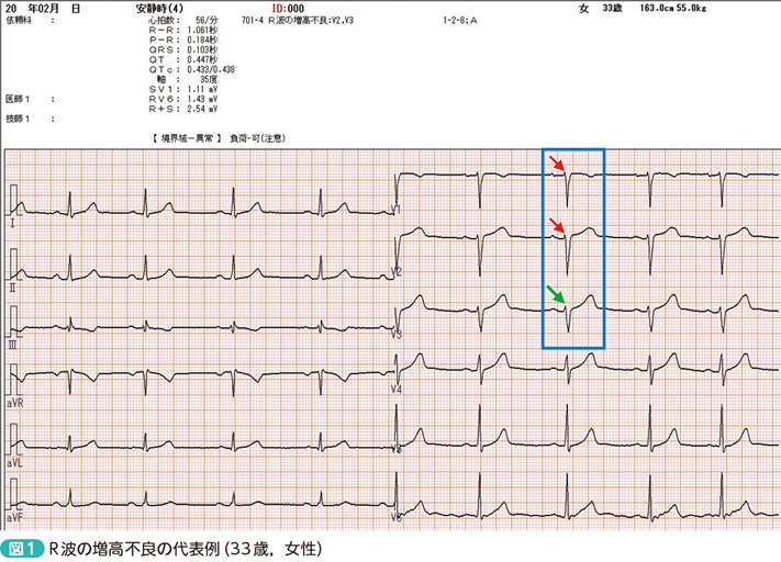第3回：R波の増高不良／Poor R-wave progression – 日本医事新報社