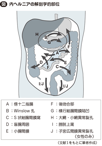 内ヘルニア［私の治療］ – 日本医事新報社