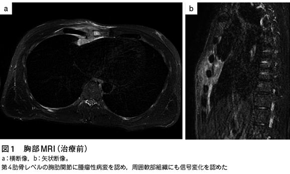 化膿性胸肋関節炎［難渋症例から学ぶ診療のエッセンス（142）］ – 日本