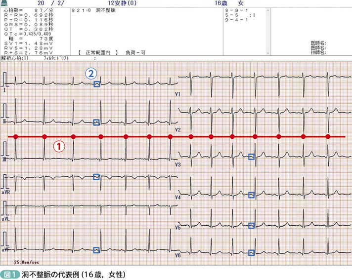 洞不整脈／Sinus arrhythmia ［Dr.ヒロの学び直し！心電図塾（第