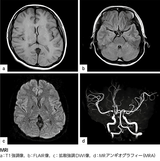 ちょっとハイレベルな頭部疾患のMRI診断 頭部MRI，MRAは正常？それとも……［画像診断道場～実はこうだった（223