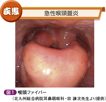 咽頭所見に乏しい咽頭痛［もう騙されない！外来に現れるミミック疾患