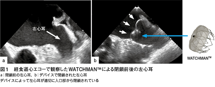 心房細動における経カテーテル的左心耳閉鎖術［学術論文］ – 日本医事