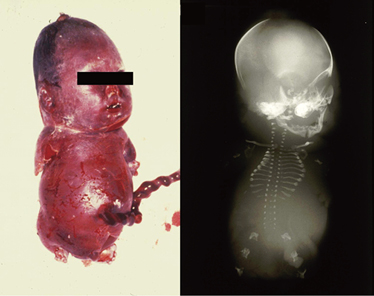 胎児骨系統疾患事始め（室月 淳）［プラタナス］ – 日本医事新報社