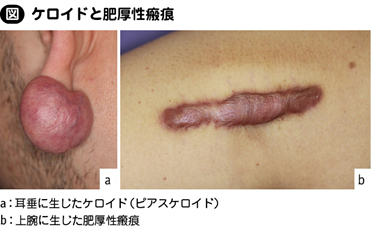 ケロイドに対する術後電子線治療の現状と今後の課題 (瘢痕・ケロイド治療ジャーナル) 瘢痕・ケロイド治療研究会 ケロイド・肥厚性瘢痕｜日本形成外科学会