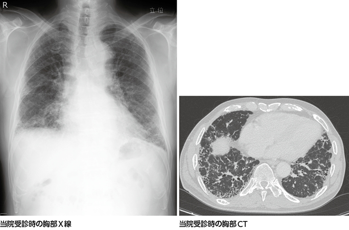 線維性間質性肺炎？［画像診断道場～実はこうだった（257）］ – 日本