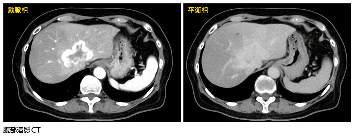この腫瘍は何？ ……診断は？［画像診断道場～実はこうだった（285