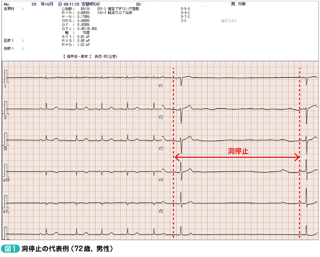 洞停止【前編】／Sinus arrest［Dr.ヒロの学び直し！心電図塾（第78回