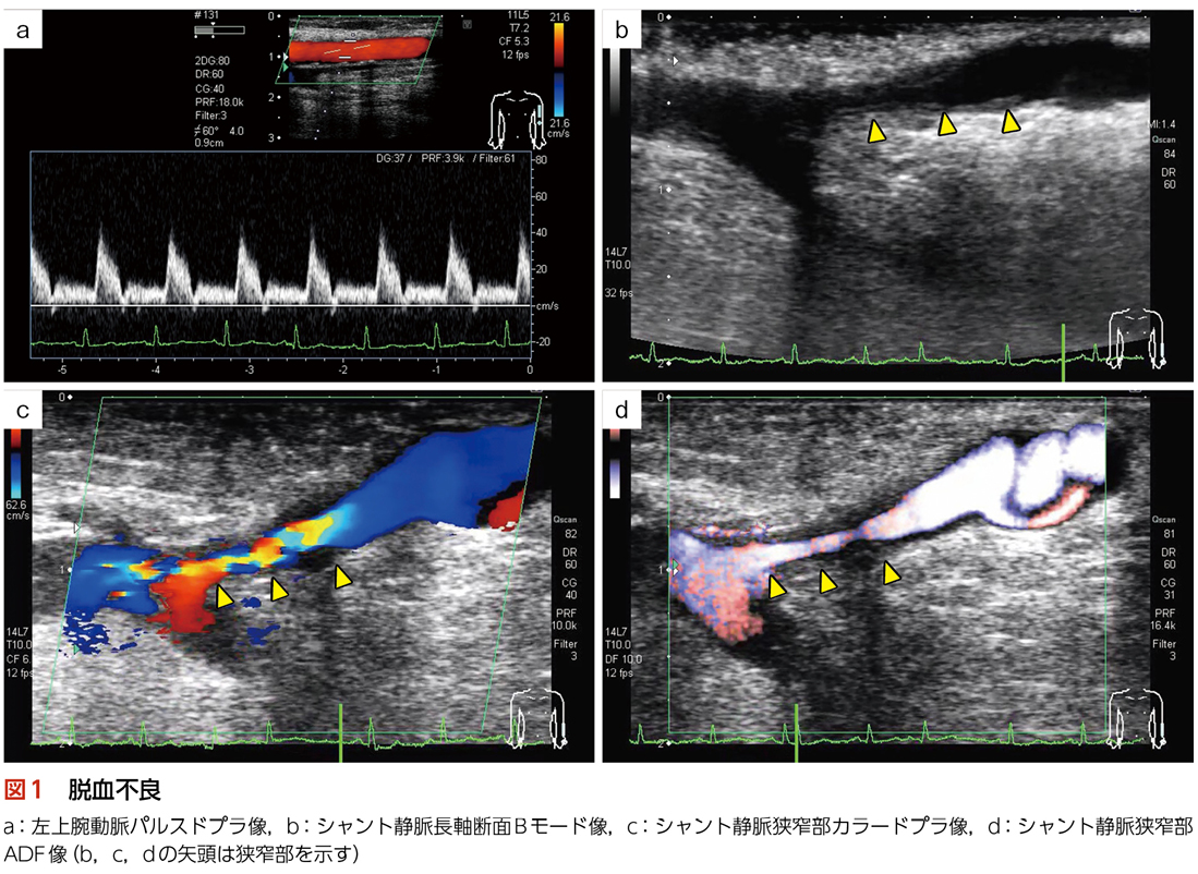 vascular access脱血不良（シャント静脈狭窄）［血管エコー職人 匠の